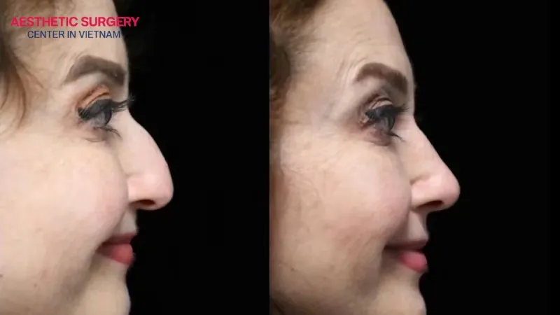 Droopy nose rhinoplasty lifts the nasal tip and creates a more harmonious face.