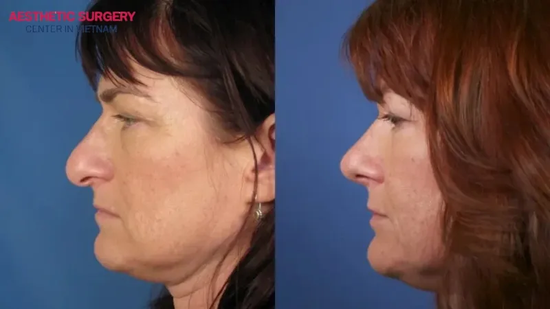 Swelling, bruising, and mild numbness may occur after droopy nose rhinoplasty.