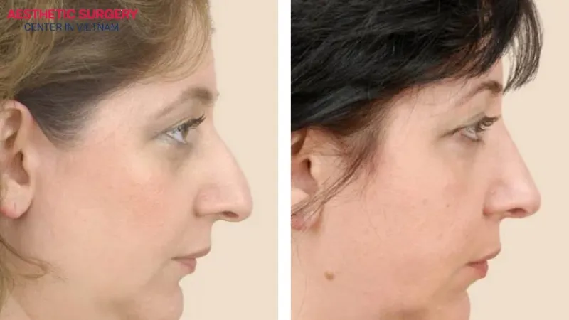 The recovery process after droopy nose rhinoplasty typically stabilizes completely after about 6–12 months.