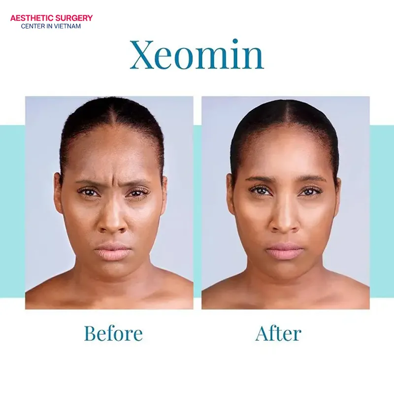 Xeomin provides a natural and elegant eyebrow lifting effect.