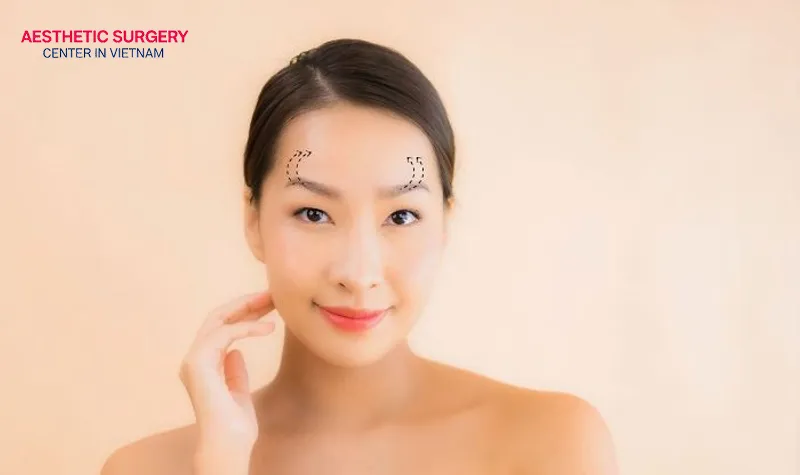 A non-surgical brow lift delivers natural beauty with a high level of safety.