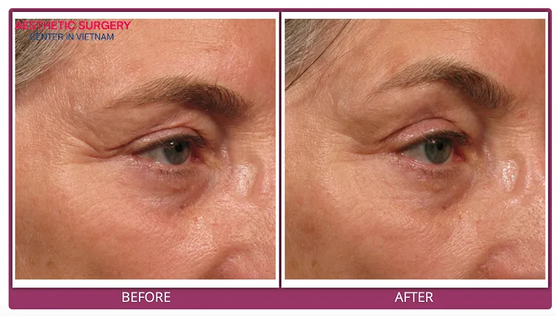 Eyebrow lifting can also help improve vision by making the eyes appear larger.