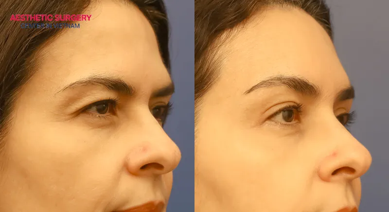 You can rest assured about the results after a non-surgical eyebrow lift.