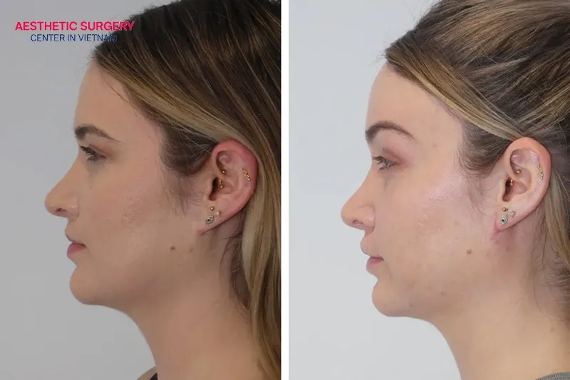 Experience a significant change after an eyebrow lift.