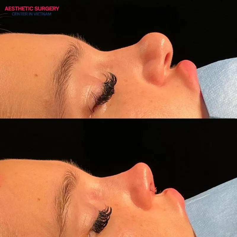 The projection of the nasal tip becomes more refined after surgery