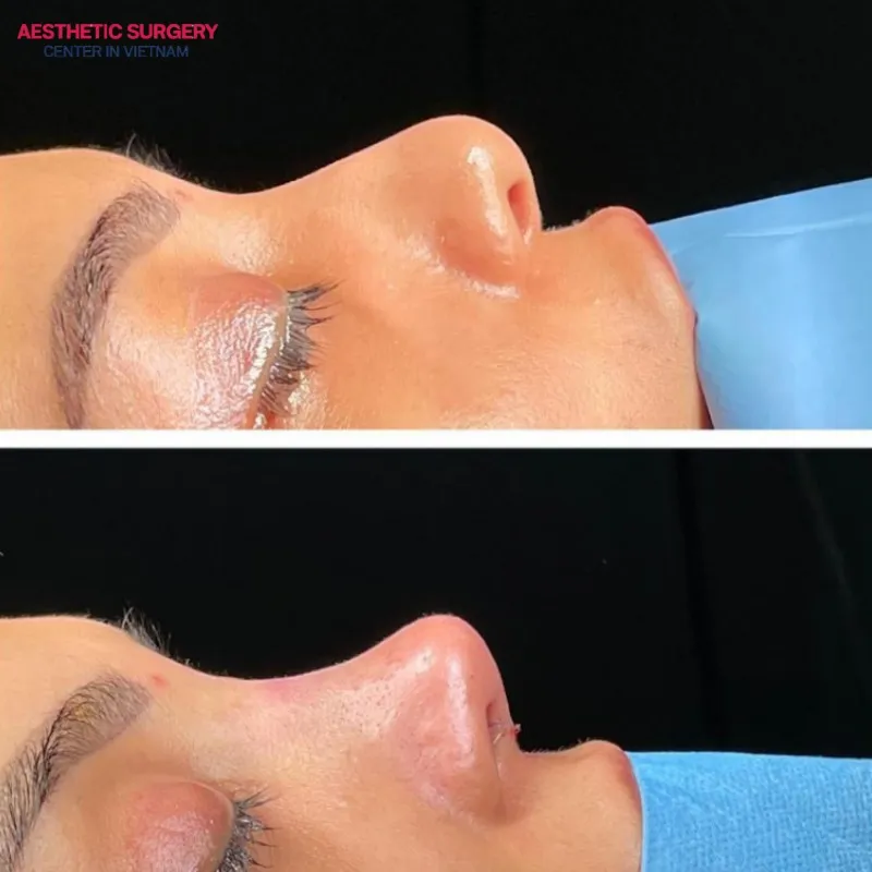 Broken nose rhinoplasty enhances the overall appearance of the nose