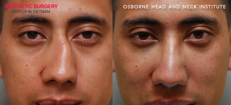 The nasal bridge becomes straight after surgery