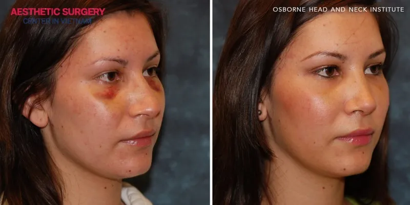 The face appears more balanced with a straight nasal bridge after surgery