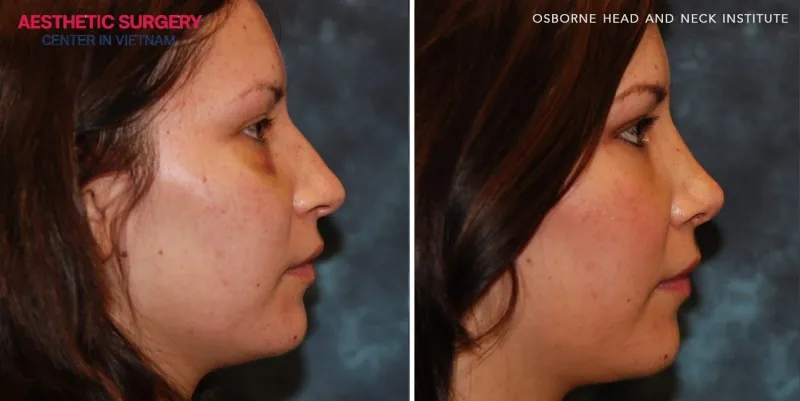 The nasal bridge appears smoother and free of irregularities