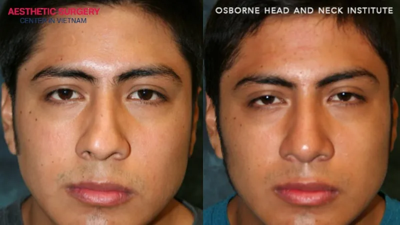 The nasal bridge becomes straight from the forehead to the tip after surgery