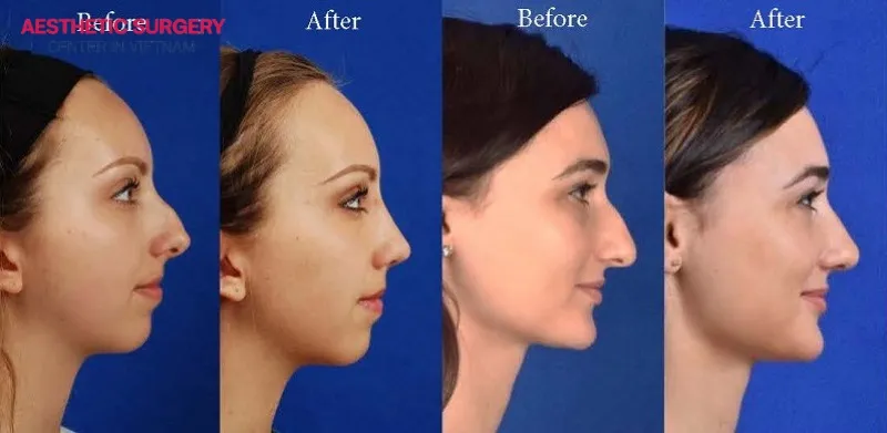 Benefits of rhinoplasty for a broken nose
