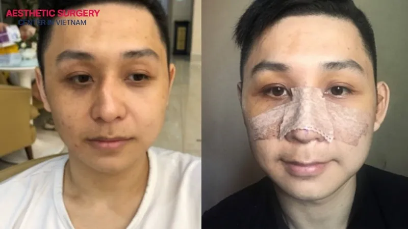 The cost of broken nose rhinoplasty depends on many factors.