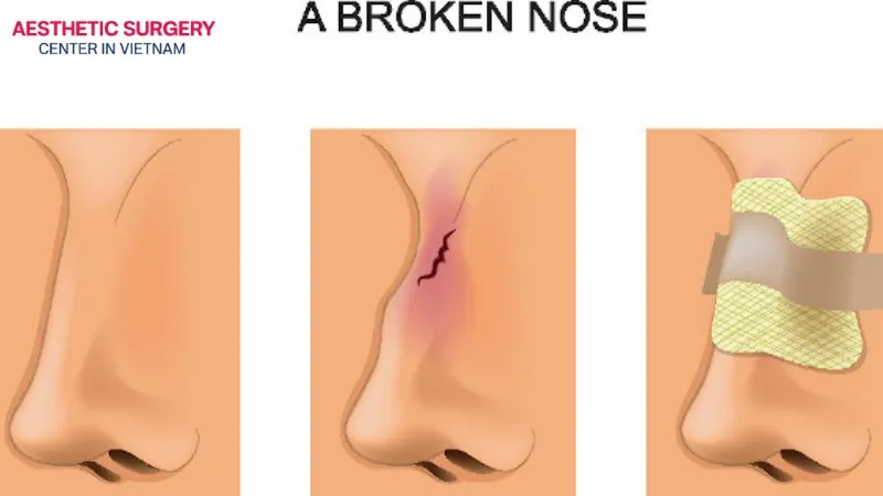 The procedure for broken nose rhinoplasty