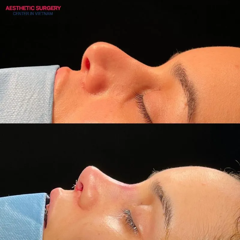 Broken nose rhinoplasty helps create a more refined nasal shape