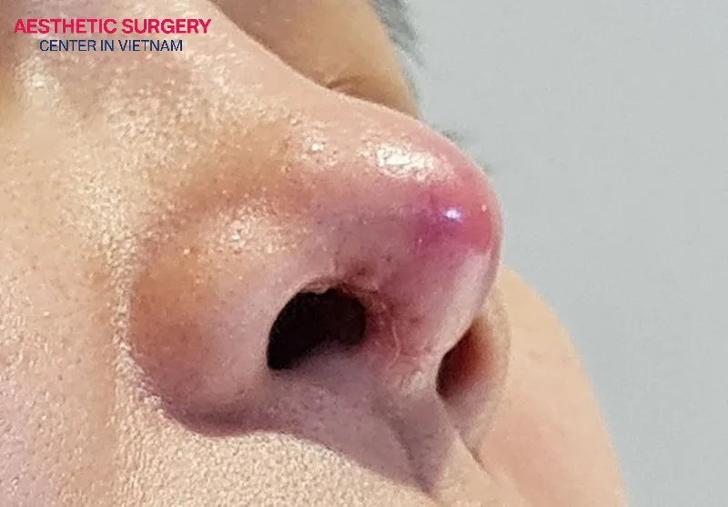 The tip of the nose is the area that takes the longest to recover after rhinoplasty.