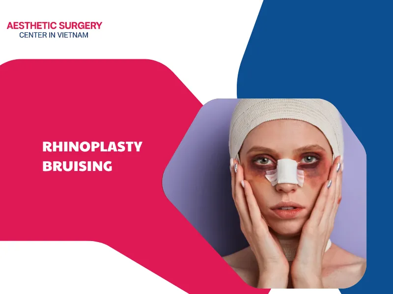 Is rhinoplasty bruising dangerous? Causes and solutions