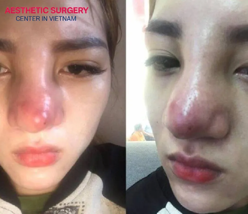 A red, swollen, and swollen tip of the nose is a sign of a damaged nose.
