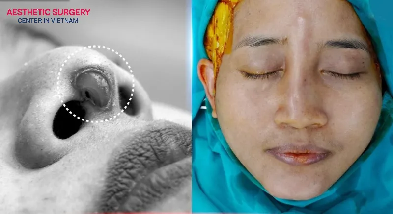 You can absolutely fix a damaged nose.