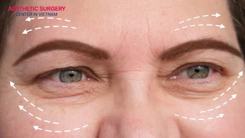 Droopy eyelid after cataract surgery is a condition where the eyelid falls lower than before the cataract surgery.