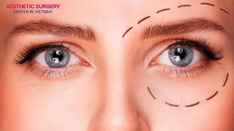 The incidence of droopy eyelid after cataract surgery ranges from about 7% to 21%.