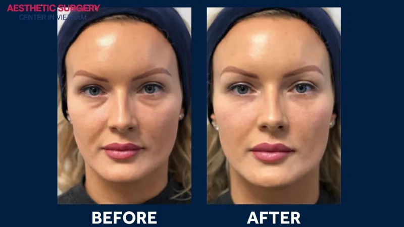 Real images before and after under eye filler results