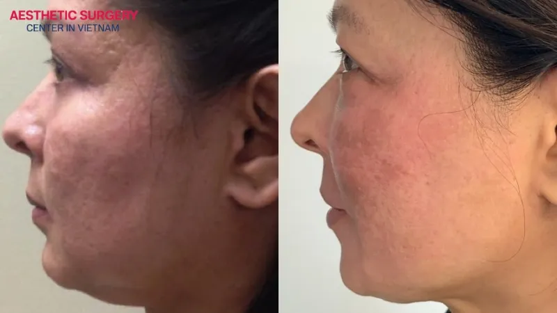 Double chin filler helps improve the chin shape without surgery.