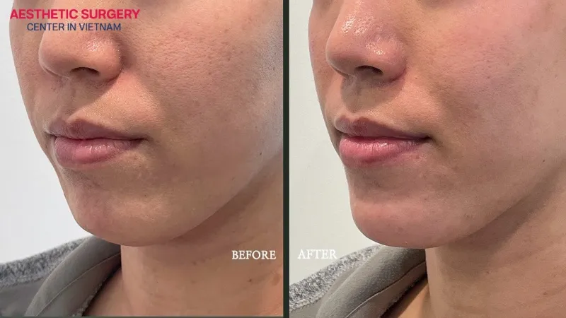 Double chin filler is usually not very painful, causing only mild discomfort during the procedure.