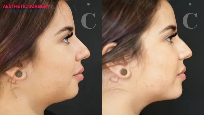 Double chin filler has a fast recovery time.