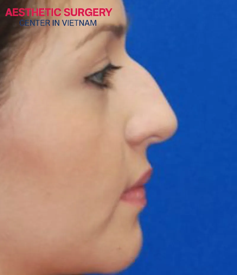 People with humped noses, crooked noses, or large deviated nasal bones are very suitable candidates for rhinoplasty using ultrasound waves.