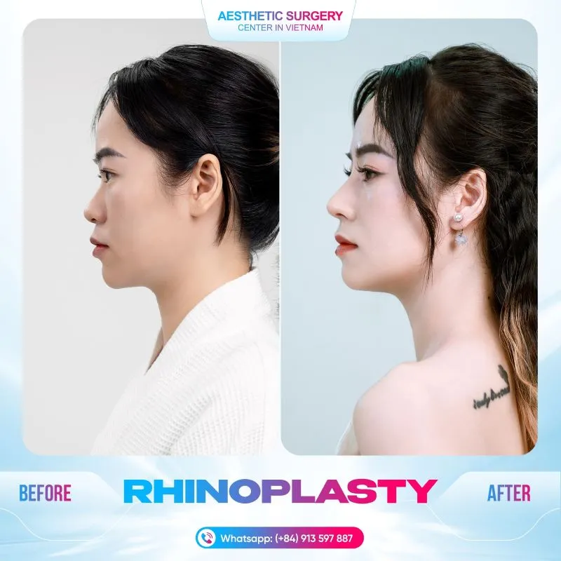 Before and after photos of a client who underwent rhinoplasty at Aesthetic Surgery Center.