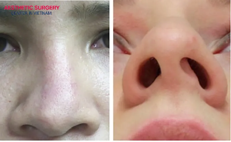 Blowing your nose at the wrong time can cause septal deviation after rhinoplasty.