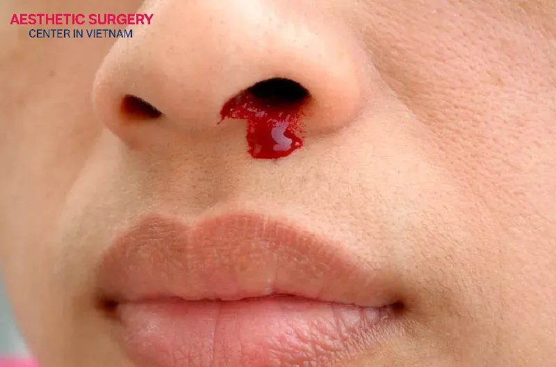 Flying too early can cause nosebleeds and infections.