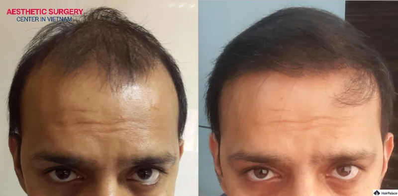 Artificial hair transplant is a method that uses synthetic hair fibers to be implanted directly into the scalp layer