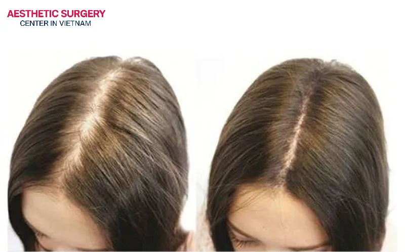Artificial hair transplant offers a fast recovery time, making it perfectly suited for those with a busy lifestyle.