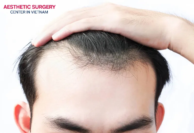 People with widespread baldness or thinning hair are suitable candidates for hair transplantation