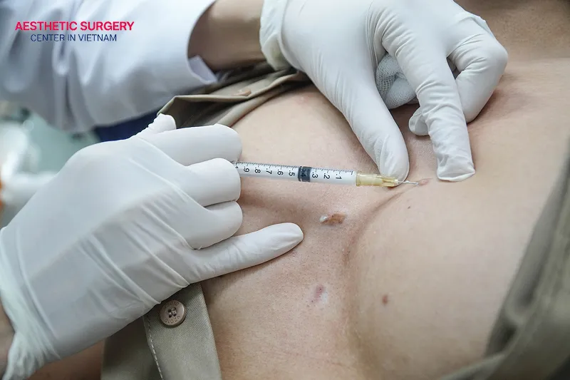 Corticosteroid injections may be used for raised or hardened scars.