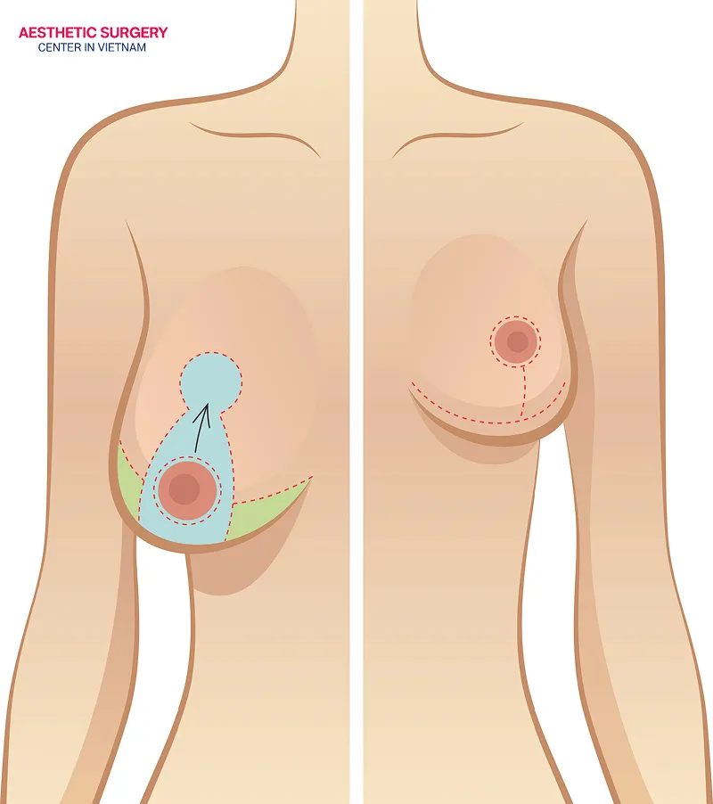 This procedure is suitable for those who feel self-conscious about overly large breasts.
