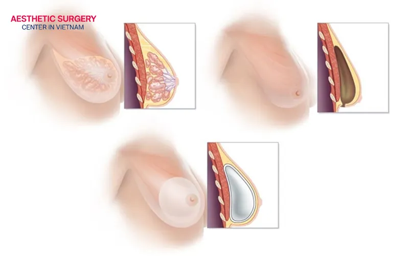 Breast reduction with implants procedure