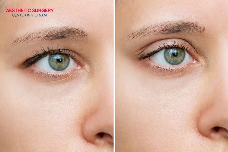 You can fully recover within one month after an eyebrow lift.