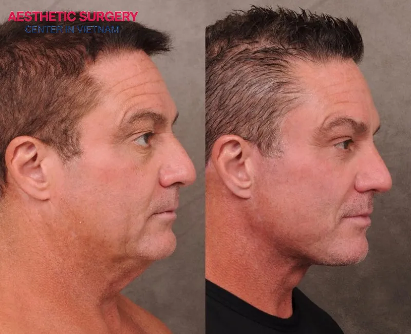 Additional costs such as anesthesia, facility fees, and post-operative care can also have a significant impact on the overall cost of neck lift surgery
