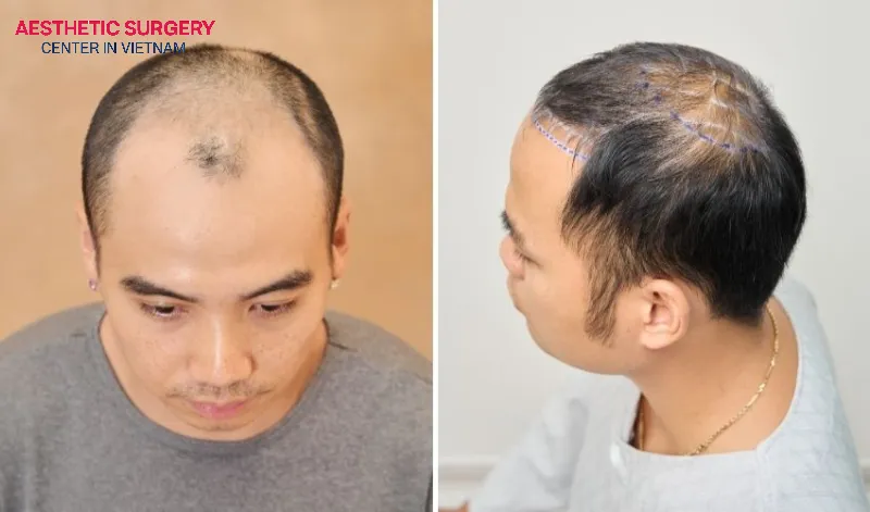 Hair transplantation in the crown area is a method of restoring hair in the crown area using artificial or autologous hair