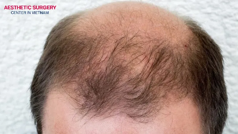 People with baldness in the crown area are very suitable candidates for crown hair transplantation.
