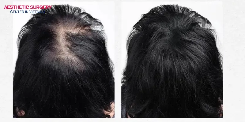 Hair transplantation on the crown of the head helps fill in bald areas, creating a youthful appearance and boosting your confidence