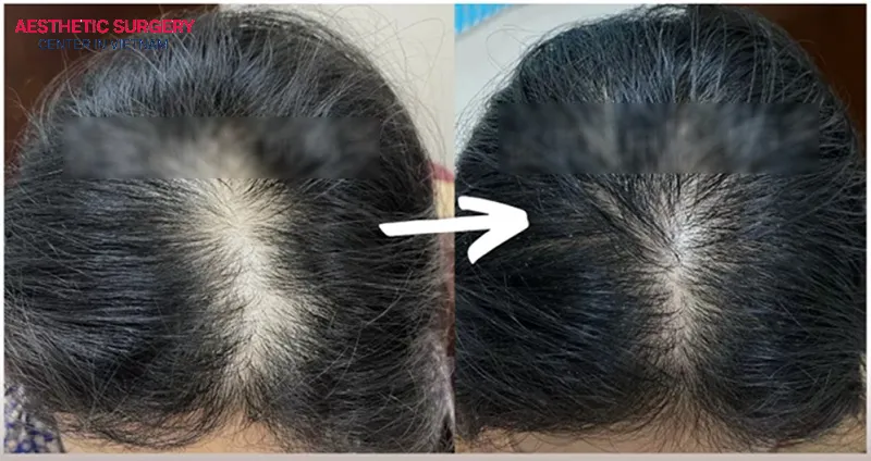 Hair transplantation performed at a reputable facility can provide long-lasting results