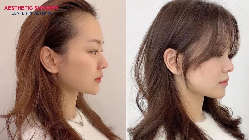 With proper care, hair will recover and regain its aesthetic appeal within 12 months