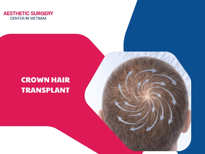 What is a crown hair transplant? Vertex restoration costs & value