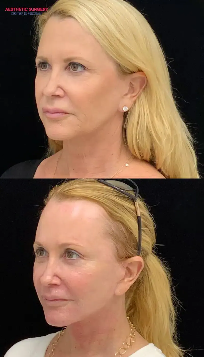 A sliding eyebrow lift leaves minimal scarring and shortens the recovery time