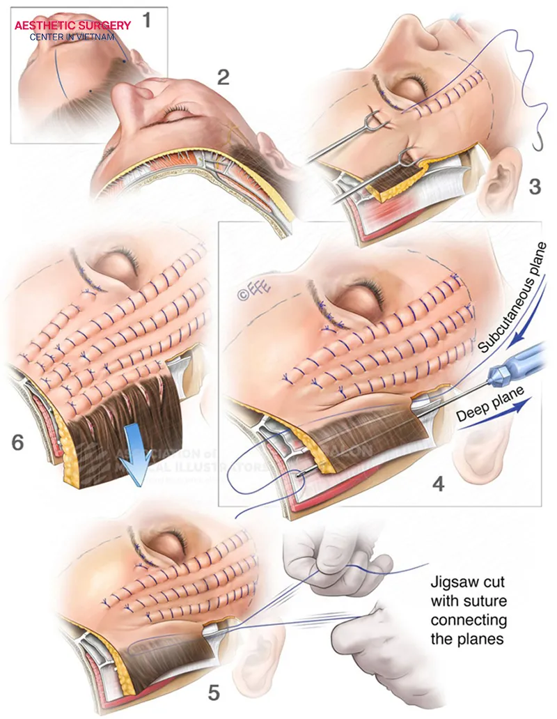 Sliding eyebrow lift procedure