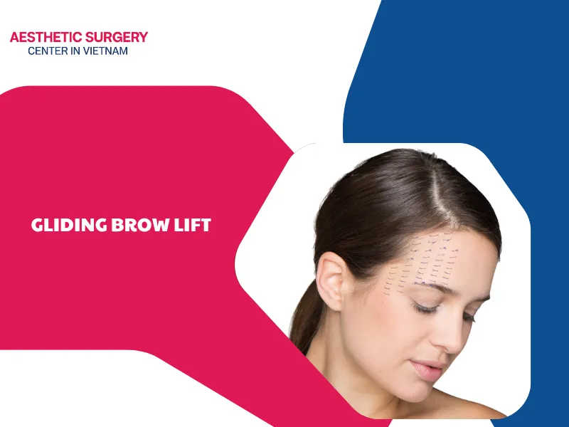 Gliding brow lift: Complete and natural eye rejuvenation