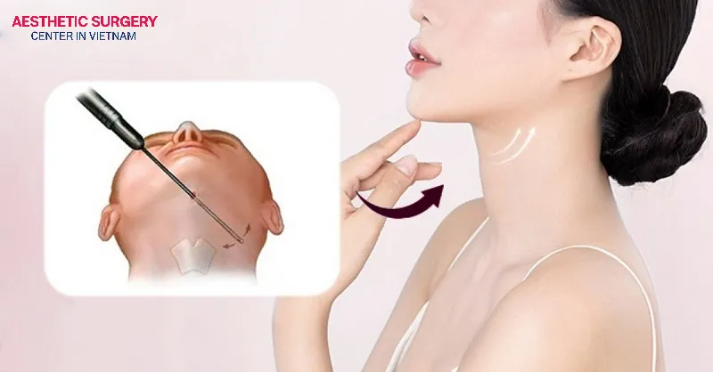 The cost of chin liposuction is also influenced by the complexity of the techniques performed.